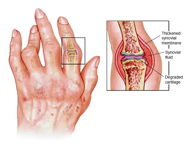 Acne & Pimples Treatment